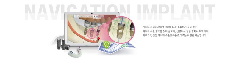 No incision Navigation implant , Seoul 관련 이미지 3