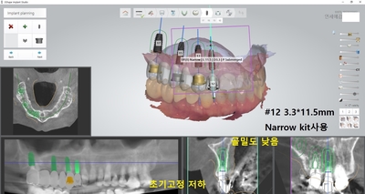 시청역,광화문 직장인에게 필요한 빠른 임플란트! 수술이 무서운 어르신들에게 만족도 높은 임플란트! 관련 이미지 1