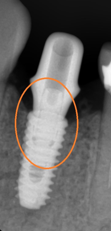 [서울시청역치과] 다른 치과에서 오래전에 한 임플란트가 흔들려요 &rarr;재수술 케이스 관련 이미지 5