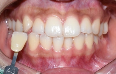 커피많이드세요? 치과에서 하는 치아미백 알려드려요[효과, 유지 등등 실제사례] 관련 이미지 12