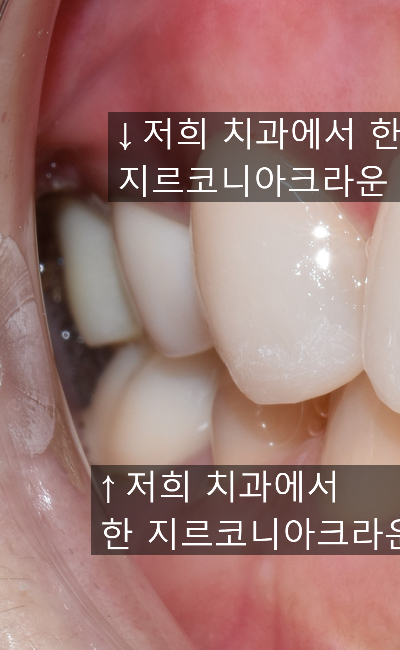 해외에서도 찾아오는 [시청역 연세예감치과]에서 알려드리는 지르코니아크라운 관련 이미지 5