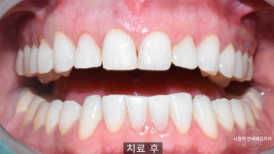 앞니 레진이 오래되어서 변색된 레진 교체 케이스 서울 시청 치과 관련 이미지 6