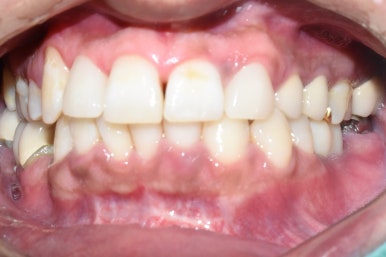 1.송곳니를 다른 앞니 모양 라미네이트로, 2.치아사이 빈공간을 라미네이트로 관련 이미지 6