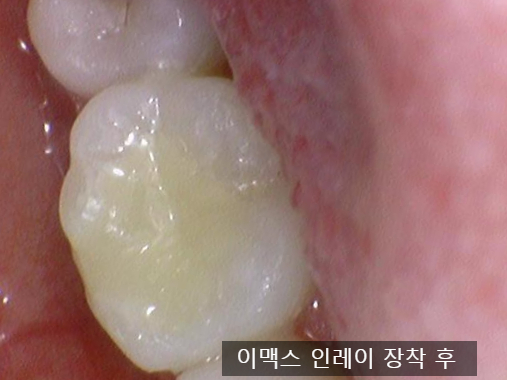 [충정로/치과] 인레이해야한다고 진단받으셨나요? 이맥스(세라믹)인레이 실제케이스 같이 살펴보아요 관련 이미지 7