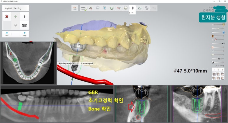 [시청역/을지로] 임플란트 진단 상담 비용? 관련 이미지 14