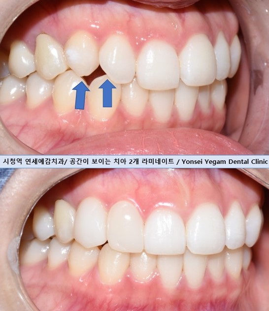 앞니가 작아 고민이신가요? 왜소치 무삭제 라미네이트로 자연스럽게 해결! 해외에서도 찾아오는 치과 비용까지 관련 이미지 6