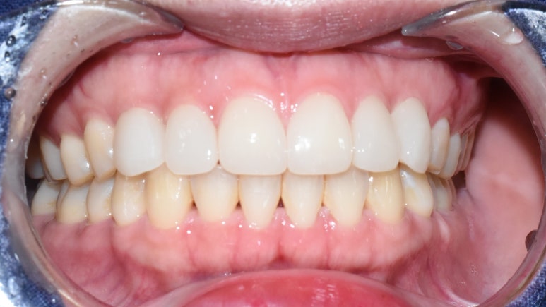 서울 시청역/서울역/ 벌어진 앞니, 왜소치 라미네이트 유명한 치과/ 전후 비교와 가격 관련 이미지 11