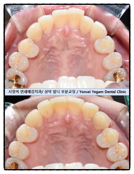 오래전 교정한 치아가 틀어져서 부분 재교정 케이스, 비용가격[광화문/서울역/치과] 관련 이미지 1