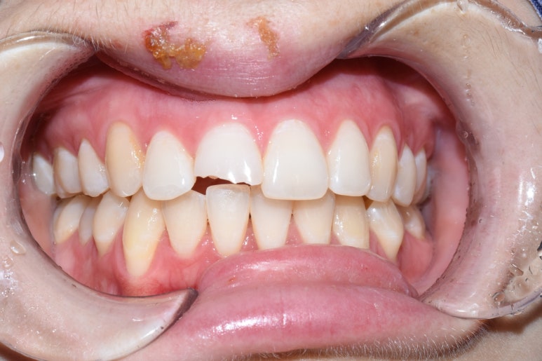 [시청역/서울역 치과] 앞니 치아부러짐 자연스럽게 치료사례 관련 이미지 6