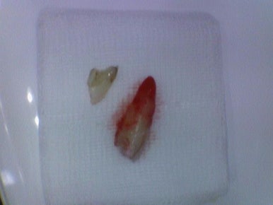 앞니 하나가 부러졌어요 앞니 크라운 앞니 브릿지 관련 이미지 9