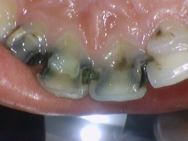 시청역치과 치아가 부러졌어요 치아가 너무 많이 썩어서 앞니가 거의 없는 치아의 크라운 케이스 관련 이미지 5