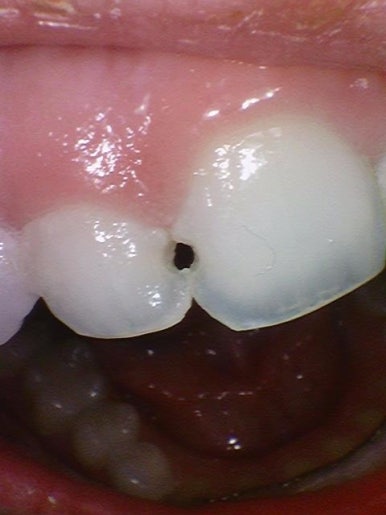 해외에서도 찾아오는 앞니레진치료, 광화문 시청역 서울역 근처 연세예감치과 외국인도 찾는 이유 관련 이미지 3