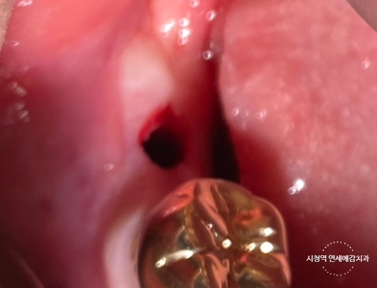 시청역 광화문  최소절개 또는 비절개로 가능한 네비게이션 임플란트 유명한 치과 내비게이션소개드려요 관련 이미지 1