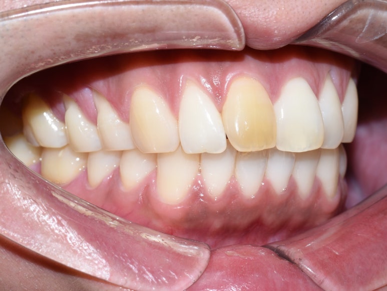 서울 시청역 치과 &ldquo;앞니 하나만 색깔이 달라요&rdquo; 관련 이미지 4