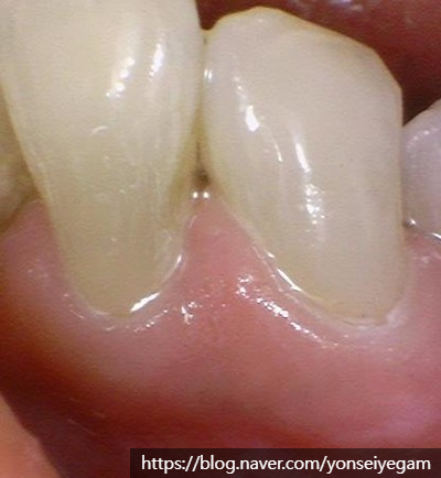 [서울역/시청역] 레진치료 : 화이트스팟(반상치) 케이스 & 치아패임으로 시린 케이스 & 깨진 치아 케이스 관련 이미지 3