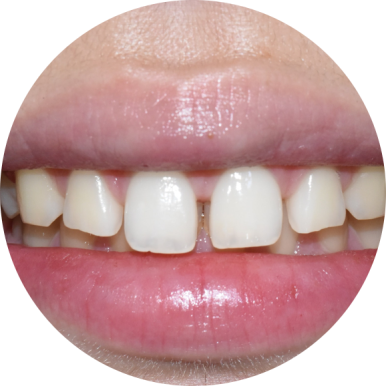 벌어진 앞니 치료, 하루에 가능, 실제케이스 및 가격 비용 관련 이미지 2