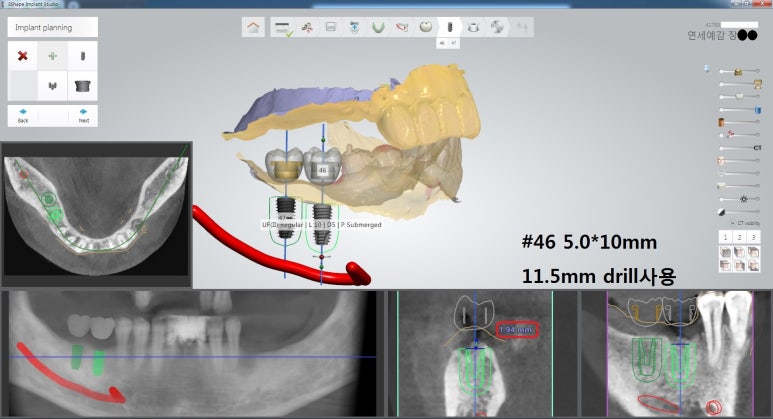[북창동 치과/연세예감치과]내비게이션임플란트소개 관련 이미지 13