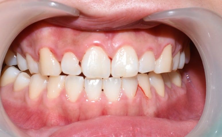 [서울역/치과] 앞니가 조금 아주조금 깨졌어요 치료가능한가요? 관련 이미지 4