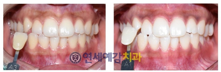 [광화문]해외에서도 찾아오는 원데이치아미백/이벤트가격/실제사례 관련 이미지 5