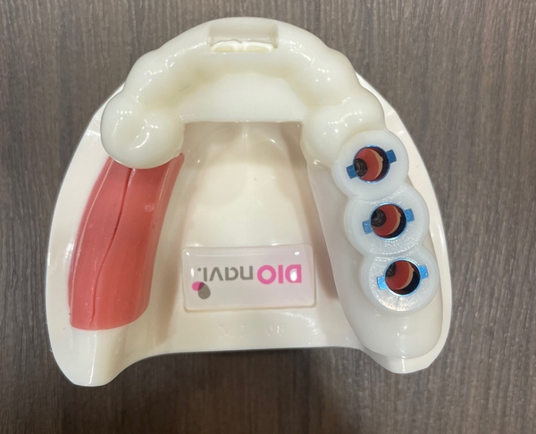 서대문역 가까운 치과 비절개 네비게이션임플란트 소개;덜아프게 빠른 회복위한 관련 이미지 3