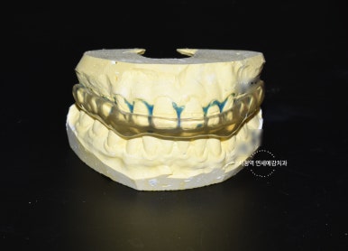 이갈이로 인한 치아 닳음 치료방법 비용 알아보아요 관련 이미지 5