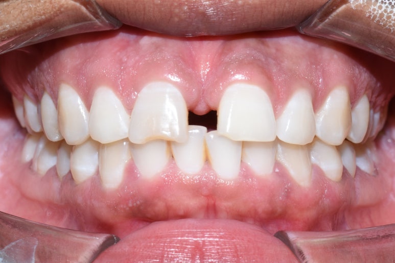 명동 가까운 치과 /외국인 흑인분의 매우 벌어진 앞니 치료 (빠른 부분교정(3개월)+라미네이트)/가격안내 관련 이미지 2