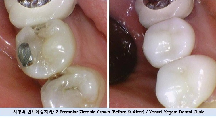 시청역치과, 신경치료 하고 크라운 꼭 해야하나요? 관련 이미지 7