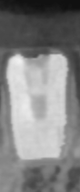 충정로 서울역 근처 고난도 & 재수술 임플란트 수술 치과 관련 이미지 9