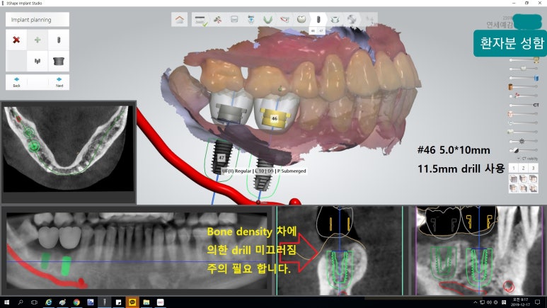 [시청역/을지로] 임플란트 진단 상담 비용? 관련 이미지 10