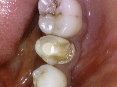 [서울/시청역]어금니 치아가 깨져서 크라운이 필요하다면? 관련 이미지 5