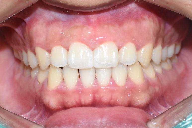 충정로 가까운치과 벌어진 치아사이 레진치료 실제사례 알려드려요 관련 이미지 6