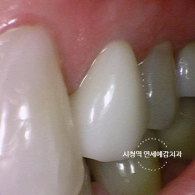 광화문 연세 예감 치과 해외에서도 찾아오는 지르코니아크라운 치료 안내해드려요 관련 이미지 21