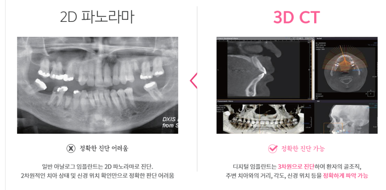 서대문역 가까운 치과 비절개 네비게이션임플란트 소개;덜아프게 빠른 회복위한 관련 이미지 1