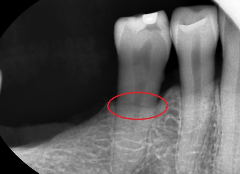 [서울역/치과] 고기 뼈를 씹고 치아가 부러졌어요 관련 이미지 3