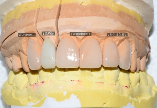 [시청역/광화문/서대문]삐뚤삐뚤한 치아 무삭제라미네이트로 치아성형 관련 이미지 5