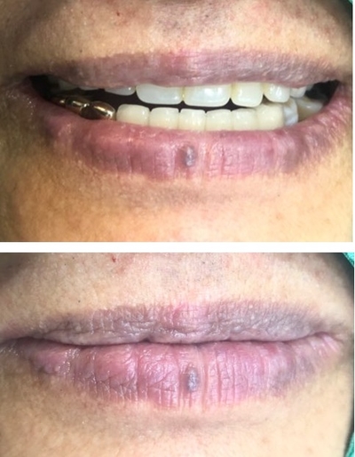 [종로/시청역]실제 환자의 보험 임플란트, 보험 틀니 사례 소개합니다. 젊어지는틀니,임플란트 치료 관련 이미지 9