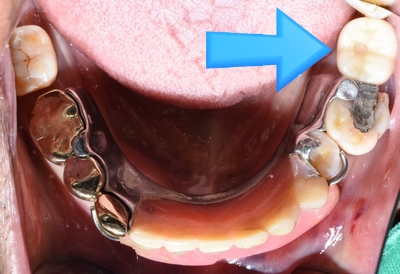 [종로/시청역]실제 환자의 보험 임플란트, 보험 틀니 사례 소개합니다. 젊어지는틀니,임플란트 치료 관련 이미지 7