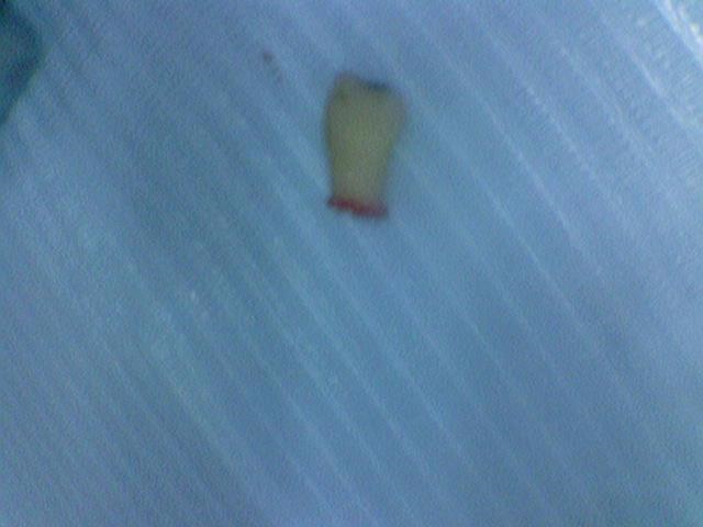 [서울역/치과] 고기 뼈를 씹고 치아가 부러졌어요 관련 이미지 4