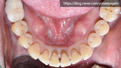 시청역 앞니교정 알아보겠습니다![실제 사례:앞니 하나가 점점 튀어나오고 벌어져요] 관련 이미지 6