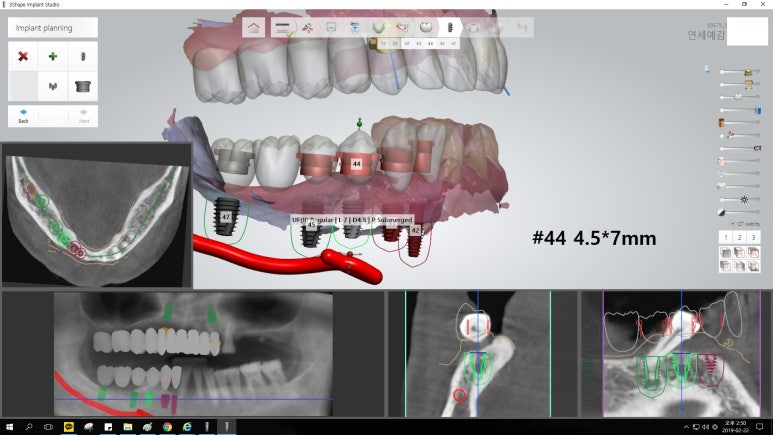[남대문시장] 임플란트 조금 더 안아프고 간편하게 관련 이미지 12