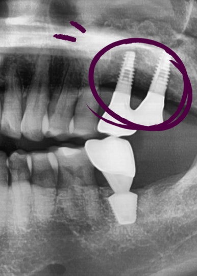 오래된 임플란트가 흔들려요 인플란트 재수술도 서울역가까운치과 연세예감치과 관련 이미지 6