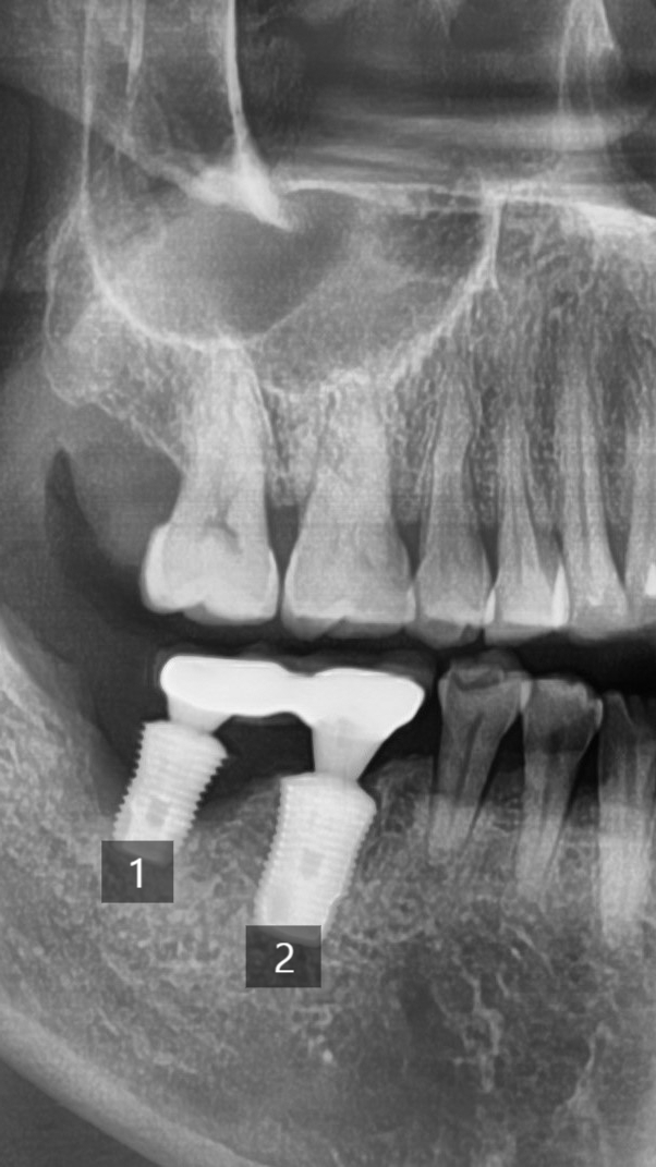 [서울시청역/케이스]"다른 치과에서 한 임플란트가 흔들려서 빼야할 것 같아요" 관련 이미지 9