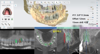 앞니 여러개 임플란트 잘하는 치과 서울역치과 실제사진 관련 이미지 12