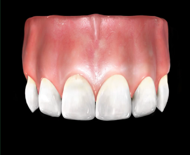 넘어져서 또는 부딪혀서 앞니 아주 많이 부러진 경우, 시청역치과 실제 앞니브릿지케이스 관련 이미지 8