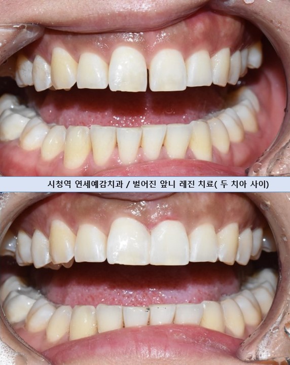 벌어진 앞니 치료, 하루에 가능, 실제케이스 및 가격 비용 관련 이미지 6