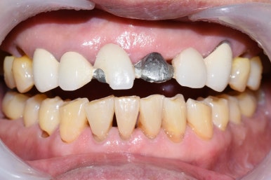 서울시청역 남대문 임플란트 대신에 앞니 브릿지를 한 케이스 관련 이미지 11