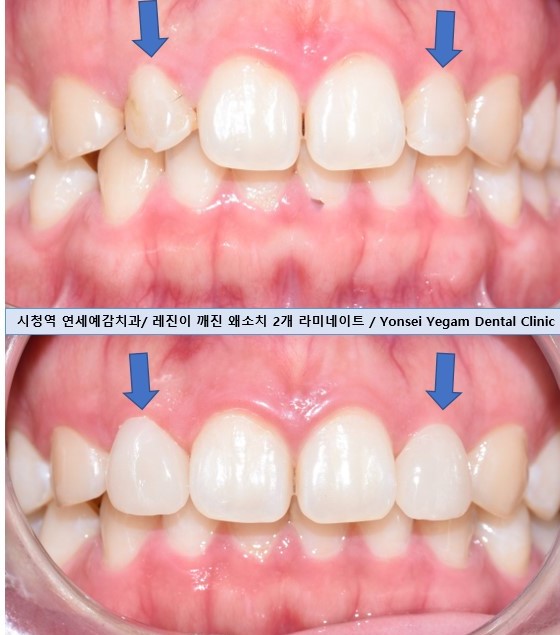 앞니가 작아 고민이신가요? 왜소치 무삭제 라미네이트로 자연스럽게 해결! 해외에서도 찾아오는 치과 비용까지 관련 이미지 5