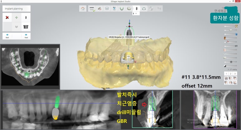 [시청역/을지로] 임플란트 진단 상담 비용? 관련 이미지 13