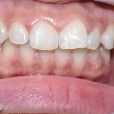 반점치, 반상치, 치아에 하얀 점 치료방법 전후사진, 가격 비용까지 관련 이미지 6