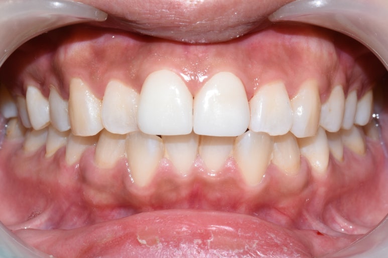 서대문역 지르코니아 크라운, 연세예감치과에서 알려드려요[실제환자사례] 관련 이미지 7